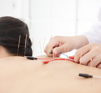 electro-acupuncture treatment