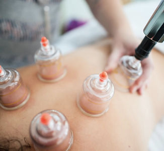 cupping treatment at East Village Acupuncture 